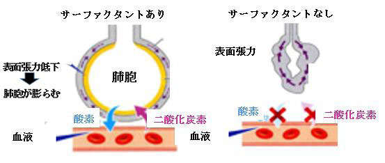 赤ちゃんに問題となる妊娠合併症-切迫早産-サーファクタントあり・なし