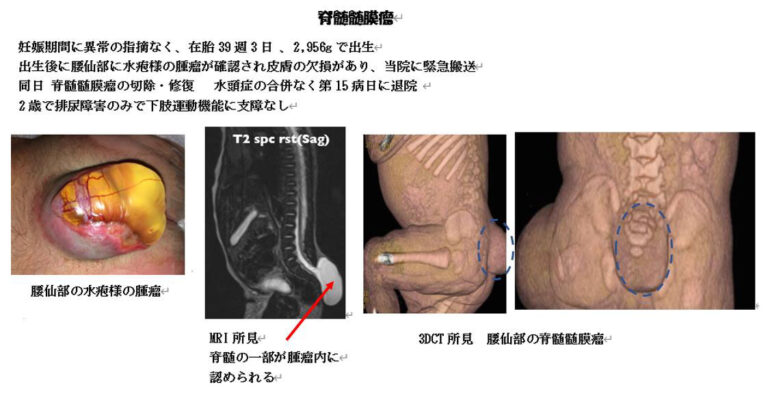 子宮外への適応-中枢神経系疾患-脊髄髄膜瘤