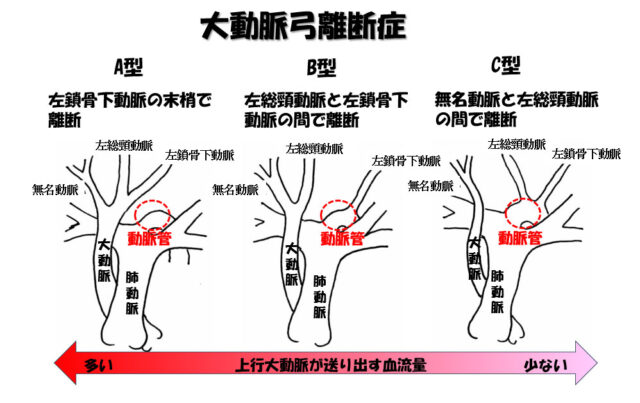 子宮外への適応-胎児循環から新生児循環へ-大動脈弓離断症