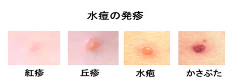 赤ちゃんに問題となる母の感染症- 水痘(水ぼうそう)水痘の発疹の種類