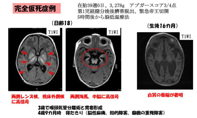 子宮外への適応-中枢神経系疾患-完全仮死症例
