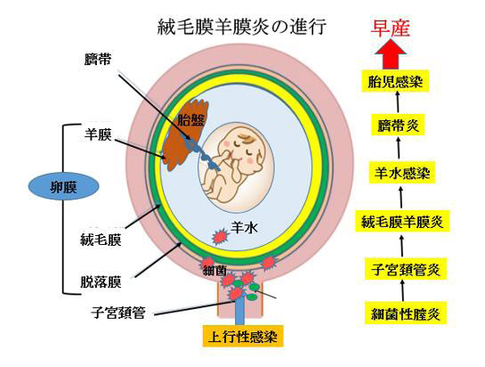 赤ちゃんに問題となる妊娠合併症-切迫早産-絨毛膜羊膜炎