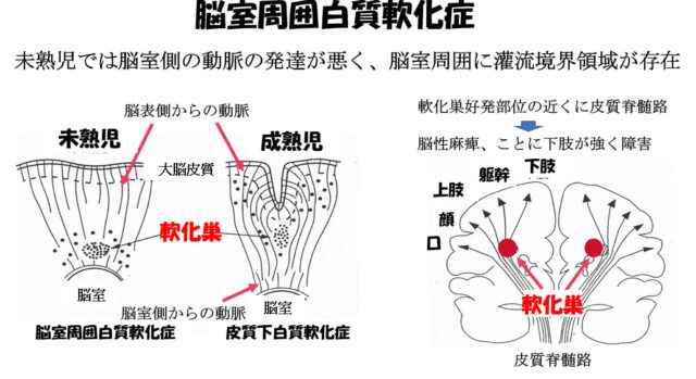 子宮外への適応-中枢神経系疾患-脳室周囲白質軟化症