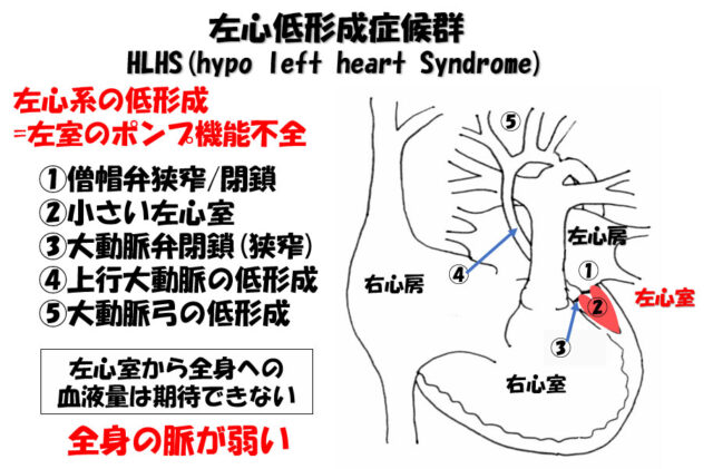 子宮外への適応-胎児循環から新生児循環へ-左心低形成症候群HLHS