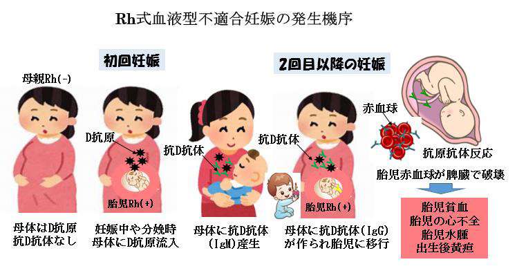 赤ちゃんに問題となる妊娠合併症 -血液型不適合妊娠-Rh式血液型不適合妊娠の発生機序