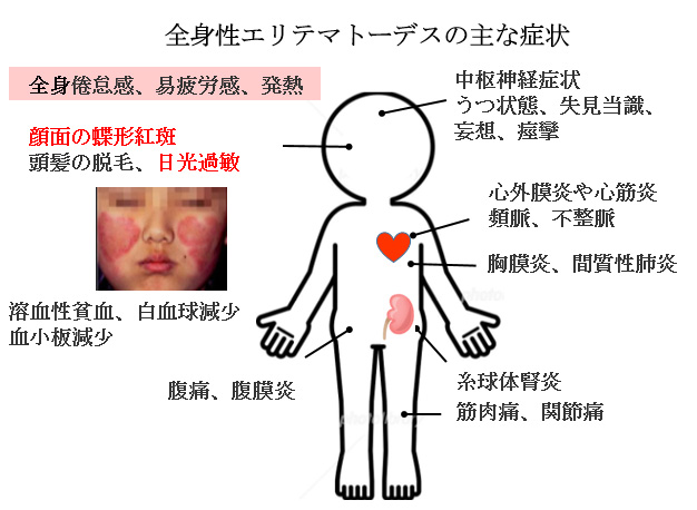 赤ちゃんに問題となる妊娠合併症-全身性エリテマトーデス-全身性エリテマトーデスの主な症状