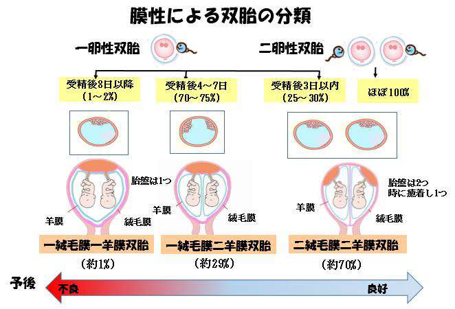 赤ちゃんに問題となる妊娠合併症-双胎-膜性による双胎の分類