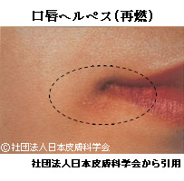 赤ちゃんに影響する母の感染症-口唇ヘルペス