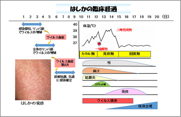 赤ちゃんに問題となる母の感染症-はしかの臨床経過