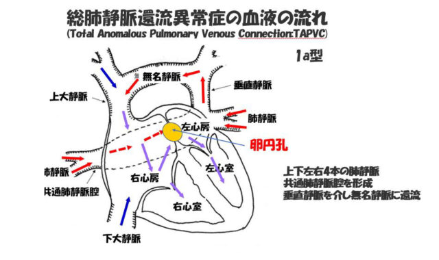 子宮外への適応-胎児循環から新生児循環へ-総肺静脈還流異常症の血液の流れ