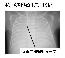 赤ちゃんに問題となる妊娠合併症-切迫早産-重症の呼吸窮迫症候群