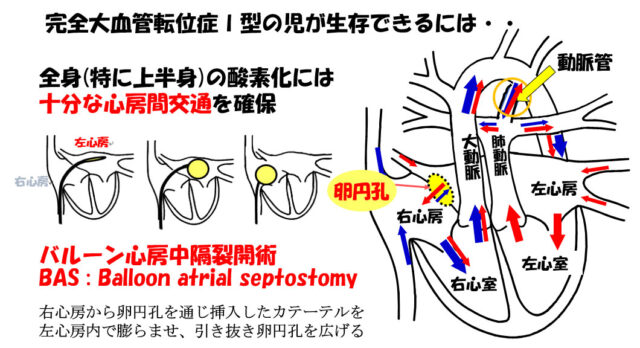 子宮外への適応-胎児循環から新生児循環へ-完全大血管転位症I型の児が生存できるには
