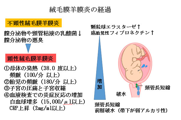 赤ちゃんに問題となる妊娠合併症-切迫早産-絨毛膜羊膜炎
