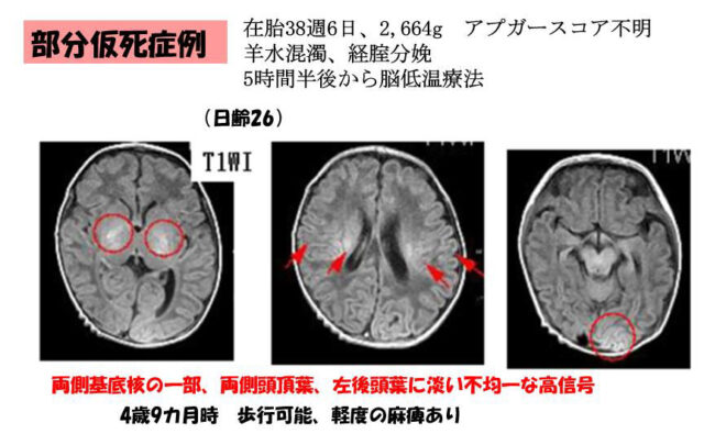 子宮外への適応-中枢神経系疾患-部分仮死症例