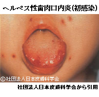 赤ちゃんに影響する母の感染症-ヘルペス性歯肉口内炎