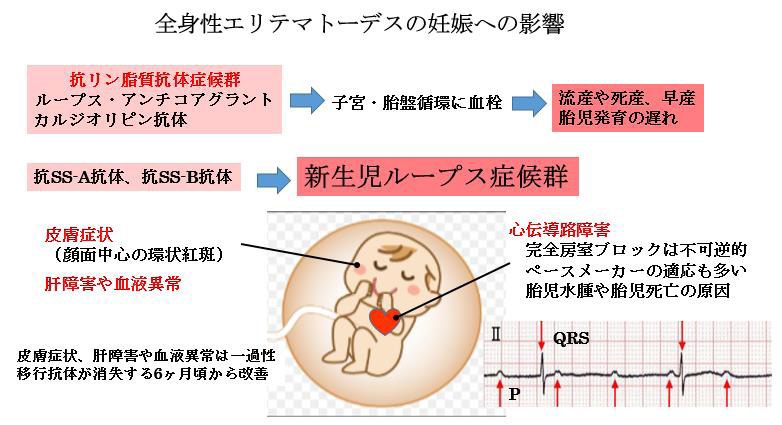 赤ちゃんに問題となる妊娠合併症-全身性エリテマトーデス-全身性エリテマトーデスの妊娠への影響