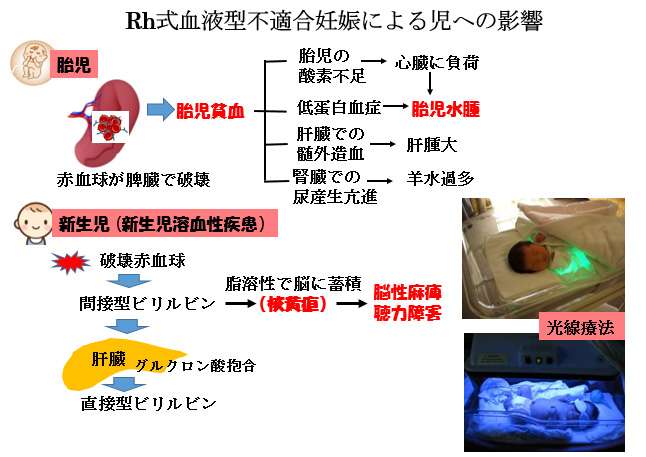 赤ちゃんに問題となる妊娠合併症 -血液型不適合妊娠-Rh式血液型不適合妊娠による児への影響