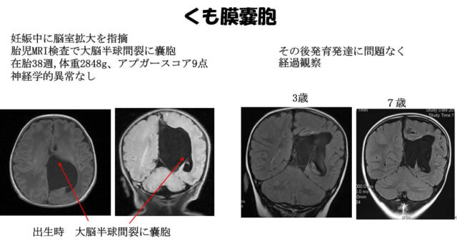子宮外への適応-中枢神経系疾患-くも膜嚢胞1