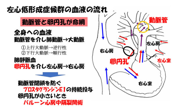 子宮外への適応-胎児循環から新生児循環へ-左心低形成症候群の血液の流れ