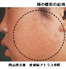 赤ちゃんに問題となる母の感染症-伝染性紅斑-頬の蝶形の紅斑