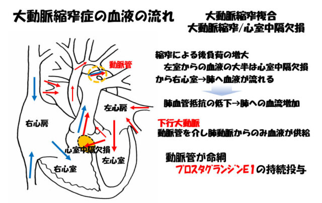 子宮外への適応-胎児循環から新生児循環へ-大動脈縮窄省の血液の流れ