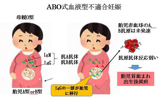 赤ちゃんに問題となる妊娠合併症 -血液型不適合妊娠-ABO式血液型不適合妊娠