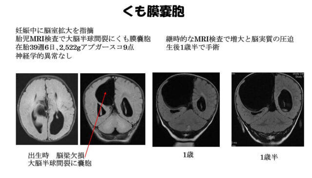 子宮外への適応-中枢神経系疾患-くも膜嚢胞2